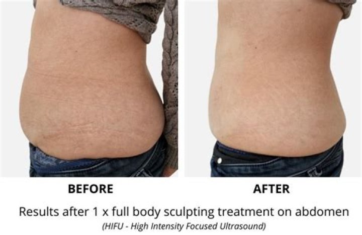 How Does Body Sculpting Work? REPC